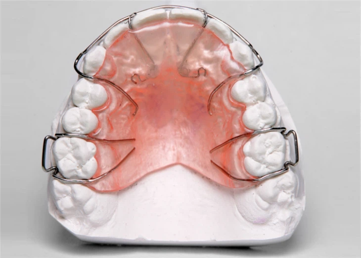traditional-hawley-retainer22303756524 (1)